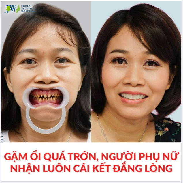 CHUYỆN LẠ: U40 GẶM ỔI QUÁ TRỚN, VÀ CÁI KẾT ĐẮNG VĂNG LUÔN HÀM RĂNG