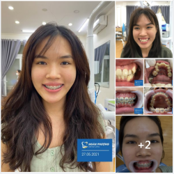CÓ CHÍ THÌ NIỀNG RĂNG