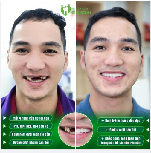 Cơ hội sở hữu hàm răng trắng sáng, đều đẹp với giá cực ưu đãi từ thương hiệu Nha khoa Gia Đình