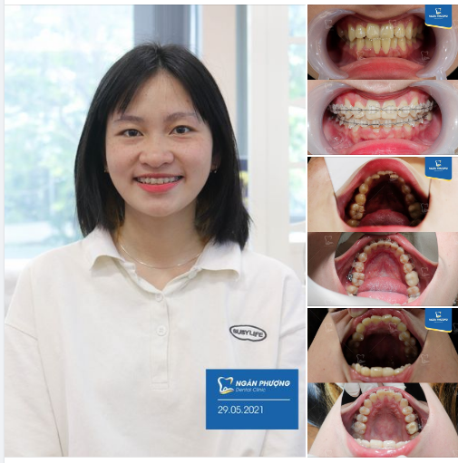 Có kiên trì ắt có thành công, chúc mừng bạn Ngọc Nga cuối năm nay sẽ được tháo niềng