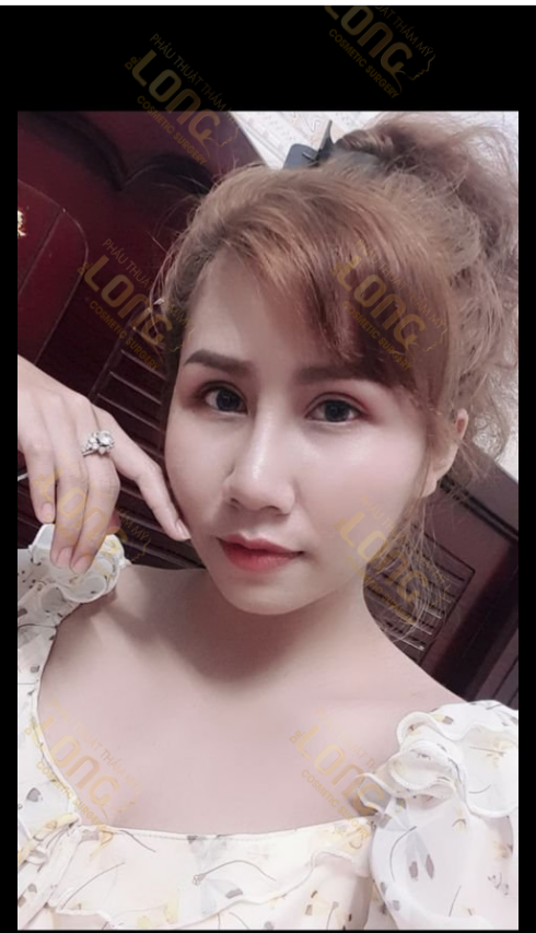 CÓ PHẢI NÂNG MŨI CÀNG CAO CÀNG ĐẸP