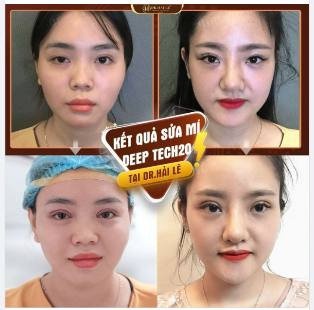 CƠ SỞ THẨM MỸ UY TÍN - Yếu tố tiên quyết cho thành công của 1 ca giải cứu mí lỗi, hỏng