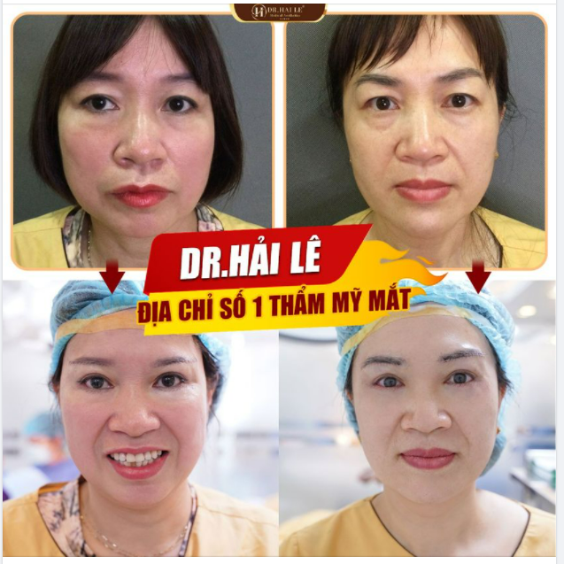 Combo Cắt mí dưới Nâng cung mày - Giải pháp cải thiện những khuyết điểm của đôi mắt