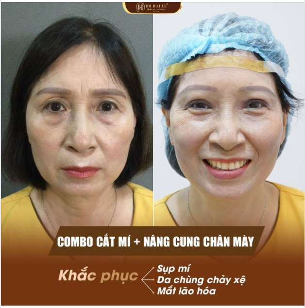 Combo Cắt mí + Nâng cung mày "Biến hình" đôi mắt là có thật