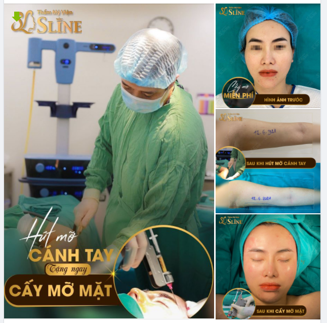 COMBO HÚT MỠ CÁNH TAY CẤY MỠ THÁI DƯƠNG