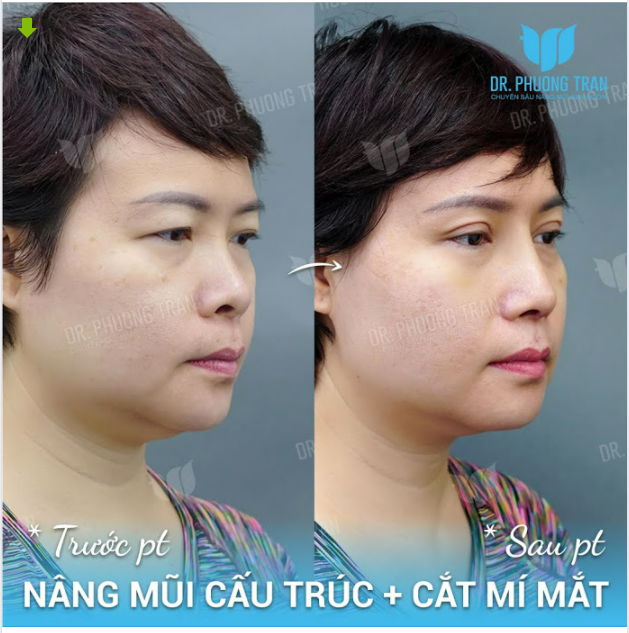 COMBO MŨI, MÍ GIÚP BẠN ẤY TRÔNG TRẺ TRUNG VÀ SANG TRỌNG HƠN NHIỀU
