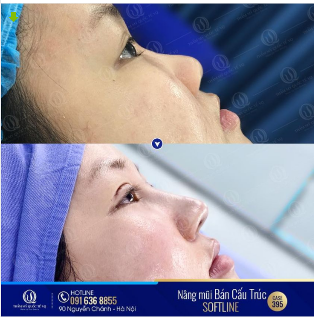 Combo nâng mũi bán cấu trúc Softline kết hợp cắt mí Baby west 9D đã giúp cô gái 2002 tiến gần tới ước mơ nghề nghiệp