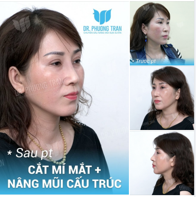 CỘNG ĐIỂM “SANG TRỌNG” NHỜ COMBO MŨI+MÍ