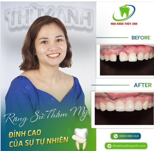 Công nghệ làm răng sứ tại nha khoa Thuỳ Anh - Ưu đãi bạt ngàn, làm răng toàn sứ chỉ từ 2.5 triệu/răng