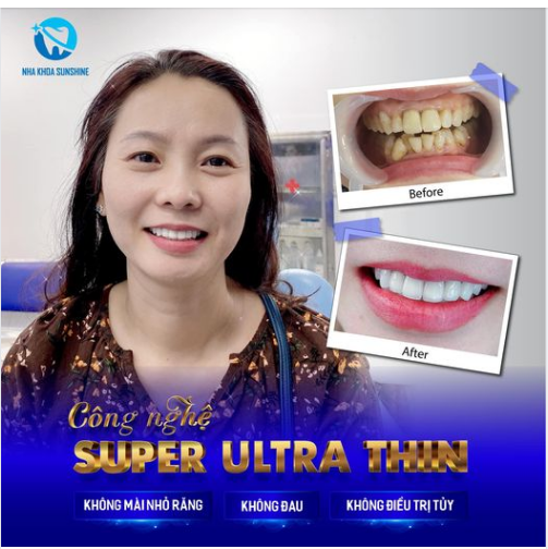 CÔNG NGHỆ SUPER ULTRA THIN – KHÔNG ĐAU, KHÔNG Ê BUỐT, KHÔNG BIẾN CHỨNG