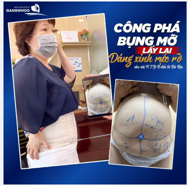 CÔNG PHÁ BỤNG MỠ LẤY LẠI DÁNG XINH RỰC RỠ CHO CHỊ P.T.Y.N ĐẾN TỪ BÀ RỊA