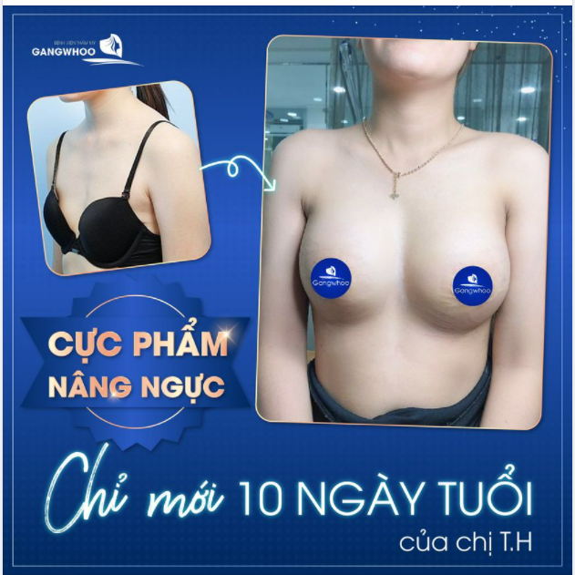 CỰC PHẨM NÂNG NGỰC 10 NGÀY TUỔI CỦA CHỊ T.H