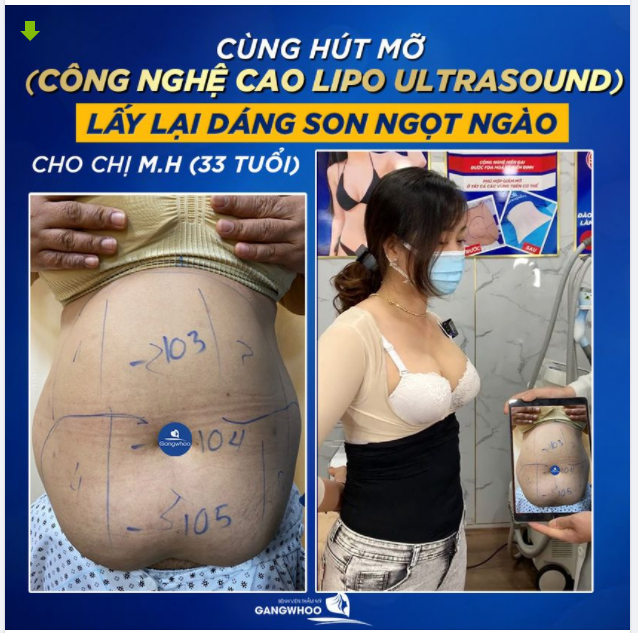 CÙNG HÚT MỠ (CÔNG NGHỆ CAO LIPO ULTRASOUND) LẤY LẠI DÁNG SON NGỌT NGÀO CHO CHỊ M.H (33 TUỔI)