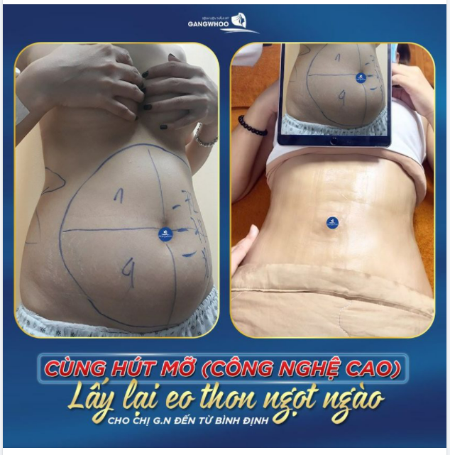 CÙNG HÚT MỠ LIPO ULTRASOUND LẤY LẠI EO THON NGỌT NGÀO CHO CHỊ L.N ĐẾN TỪ BÌNH ĐỊNH