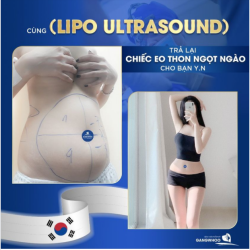 CÙNG LIPO ULTRASOUND TRẢ LẠI EO THON NGỌT NGÀO CHO BẠN Y.N