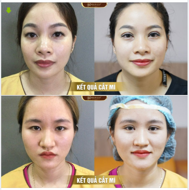 Cùng ngắm nhìn những nhan sắc đẹp vượt thời gian sau quá trình thẩm mỹ mắt tại Dr.Hải Lê