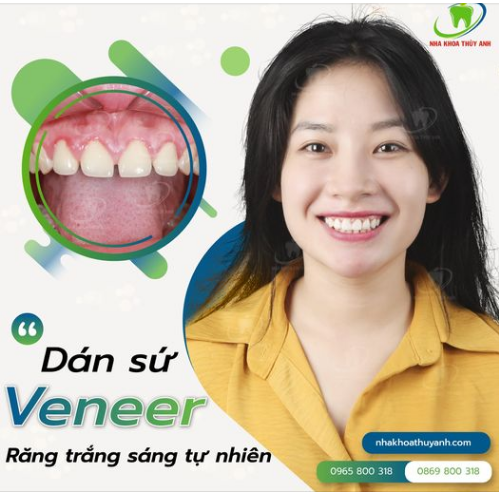 CƯỜI ĐẸP HƠN - DUYÊN HƠN CÙNG NHA KHOA THÙY ANH