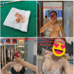 Cuối tuần cùng lắng nghe tâm sự của chị H. về trải nghiệm 10 ngày độ loa + độn cằm tại Dr. Quang Đức và có thêm động lực nhé!