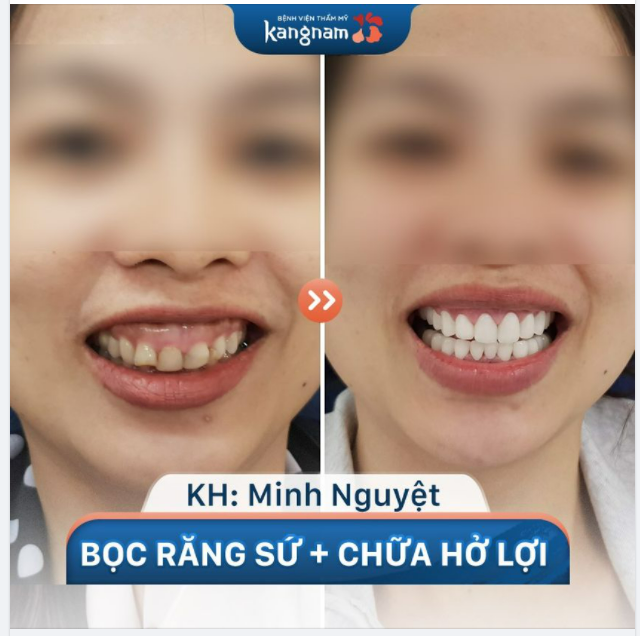 Cuối tuần đăng tạo động lực cho chị em bằng combo Bọc răng sứ + Chữa cười hở lợi!