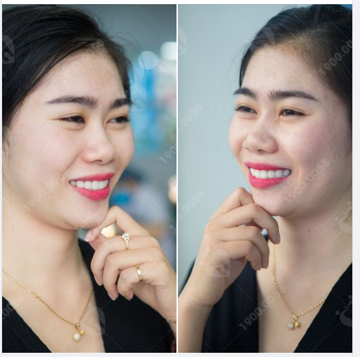 ĐÃ ĐẾN NHA KHOA GIA ĐÌNH LÀ PHẢI ĐẸP - ĐÃ LÀM RĂNG SỨ LÀ PHẢI XINH