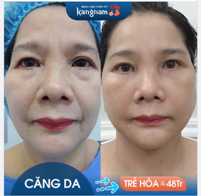 DA MẶT CHẢY XỆ nặng? Vết chân chim? Râu rồng?
