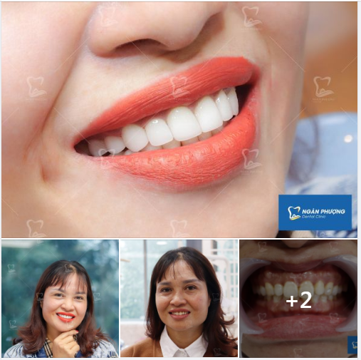 DÁN SỨ EMAX - VẺ ĐẸP THÁCH THỨC THỜI GIAN