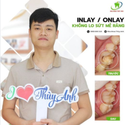 DÁN SỨ INLAY/ONLAY - GIẢI PHÁP BỀN VỮNG TIẾT KIỆM MÔ RĂNG
