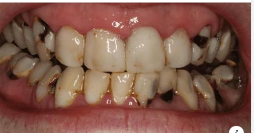 ĐANG BỊ SÂU RĂNG CÓ NIỀNG ĐƯỢC KHÔNG?