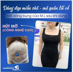 DÁNG ĐẸP MIỄN CHÊ - MÊ QUÊN LỐI VỀ VỚI DÁNG BỤNG CỦA CHỊ M.L SAU KHI DÙNG HÚT MỠ (CÔNG NGHỆ CAO) LIPO ULTRASOUND
