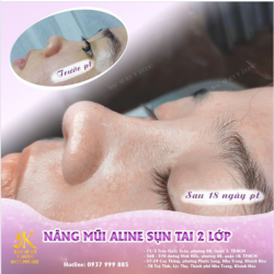 DÁNG MŨI ALINE CỰC KÌ XUẤT SẮC
