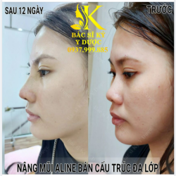 Dáng mũi Aline đẹp xuất thần chỉ sau 12 ngày cho bạn nữ Kiên Giang xa xôi.