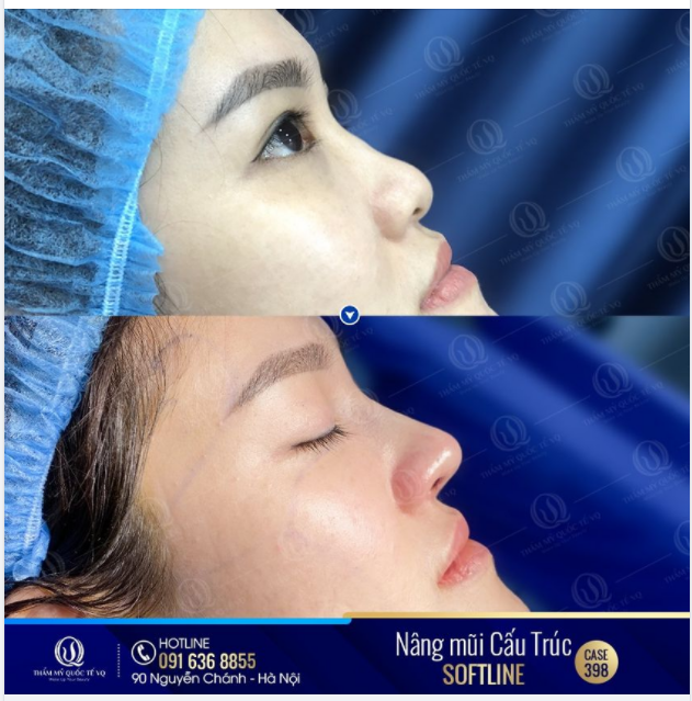 Dáng mũi cấu trúc đẹp ngay sau khi làm do Bs Vũ Quang thiết kế đã một lần nữa chinh phục được chị khách hàng đáng yêu