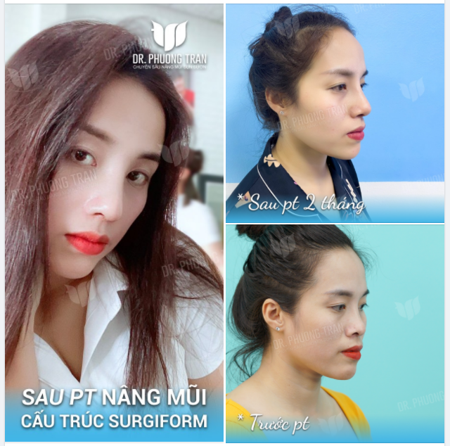 DÁNG MŨI NÀO CHO NÀNG GÒ MÁ CAO?