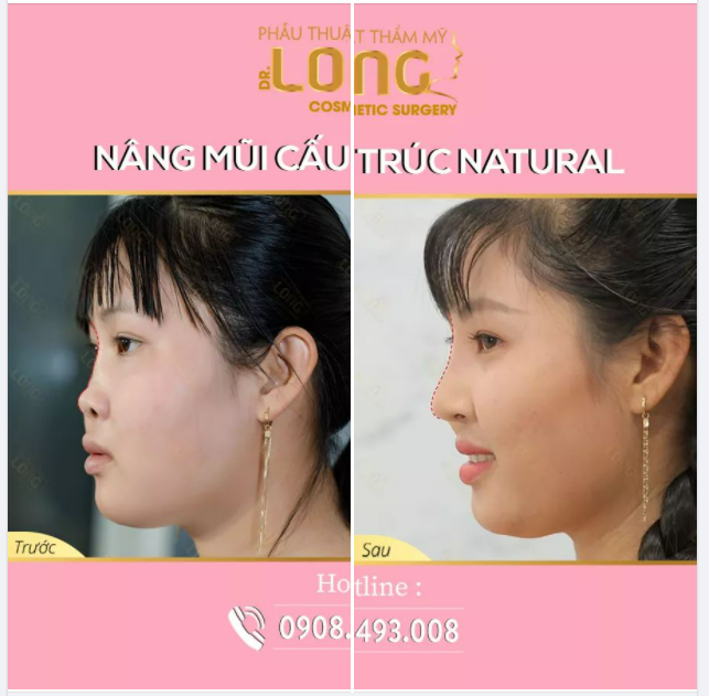 DÁNG MŨI SAU 1 NĂM THỰC HIỆN SẼ THAY ĐỔI NHƯ THẾ NÀO???