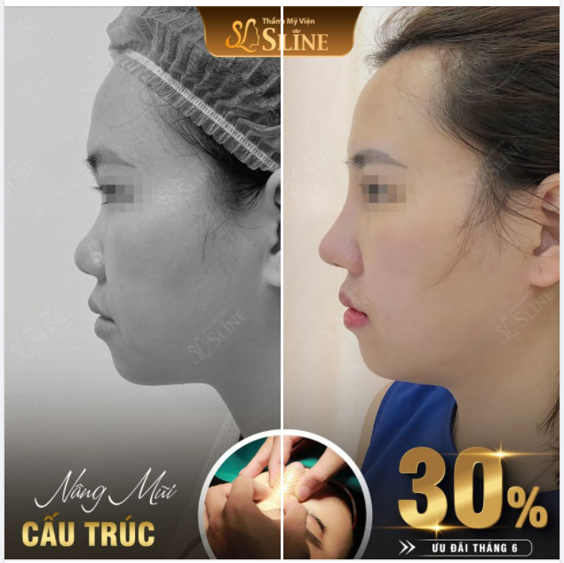 DÁNG MŨI SAU 11 NGÀY.