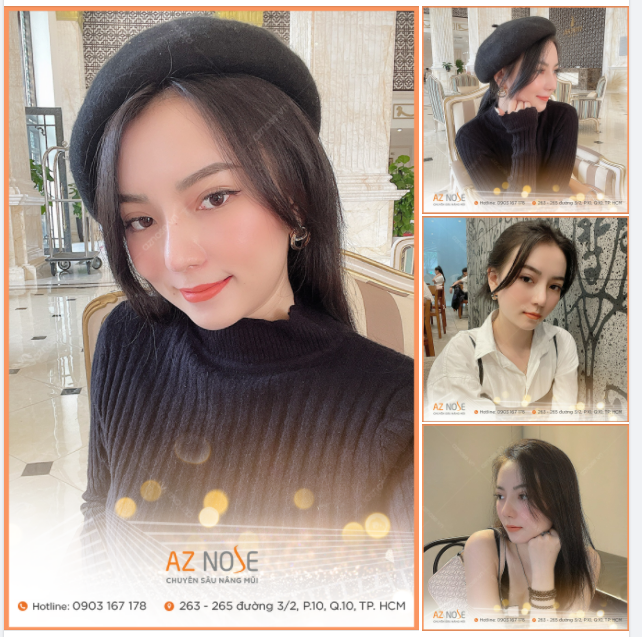 Dáng mũi sau 1,5 tháng của khách hàng AZ NOSE