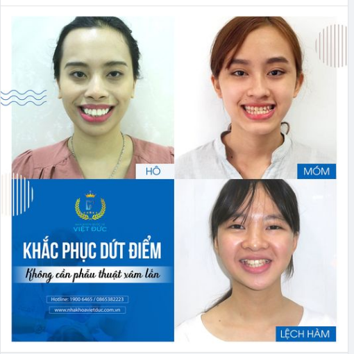 ĐÁNH BAY HÔ, MÓM KHÔNG CẦN PHẪU THUẬT XÂM LẤN