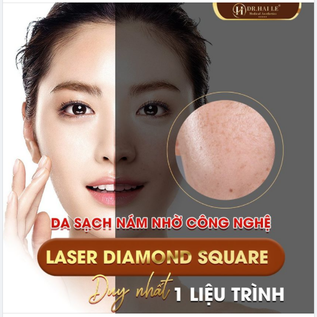 "Đánh bay" NÁM LÂU NĂM nhờ công nghệ LASER DIAMOND SQUARE!
