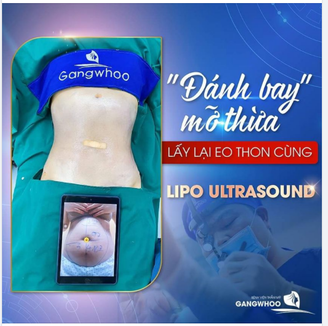 ĐÁNH TAN MỠ THỪA LẤY LẠI EO THON CÙNG HÚT MỠ (CÔNG NGHỆ CAO LIPO ULTRASOUND)