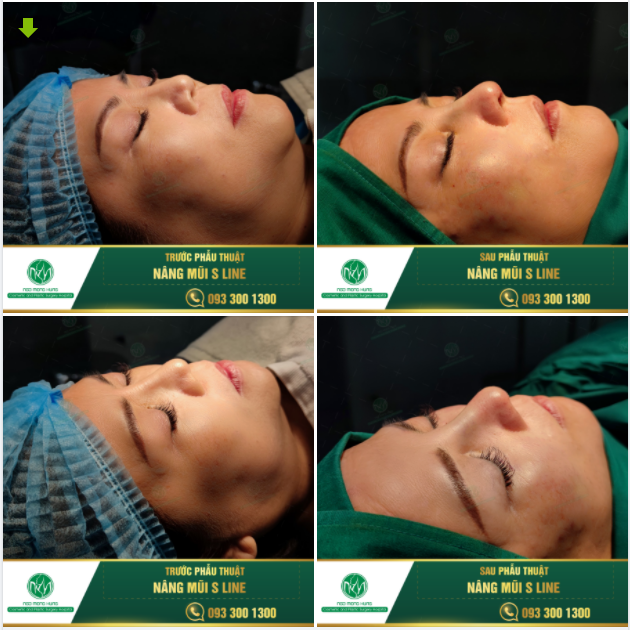 ĐÂU LÀ GIẢI PHÁP CHO DÁNG MŨI CHƯA NHƯ Ý