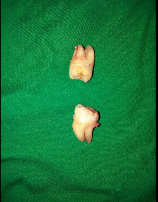 Đau làm sao được khi quá trình nhổ răng khôn tại Yteeth có sự trợ giúp của máy nhổ răng siêu âm piezotome - công nghệ nhổ răng hiện đại nhất hiện nay.