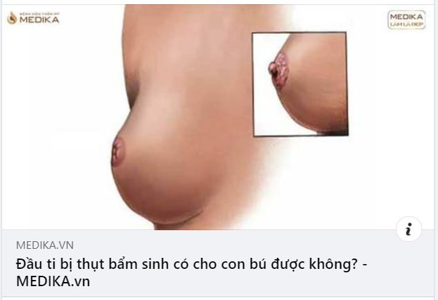 Đầu ti bị thụt bẩm sinh có cho con bú được không? Làm cách nào để đầu ti nhô lên an toàn, hiệu quả?