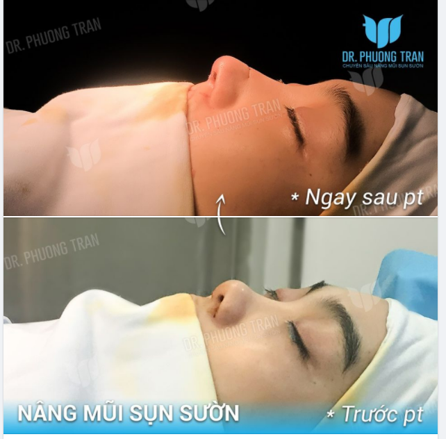 ĐÂY LÀ CHIẾC MŨI TRONG MƠ CỦA BẠN ẤY!