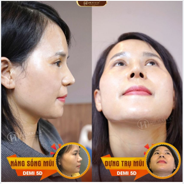 Để có 1 kết quả Nâng mũi hoàn hảo bắt buộc phải dựa trên các yếu tố sau đây: