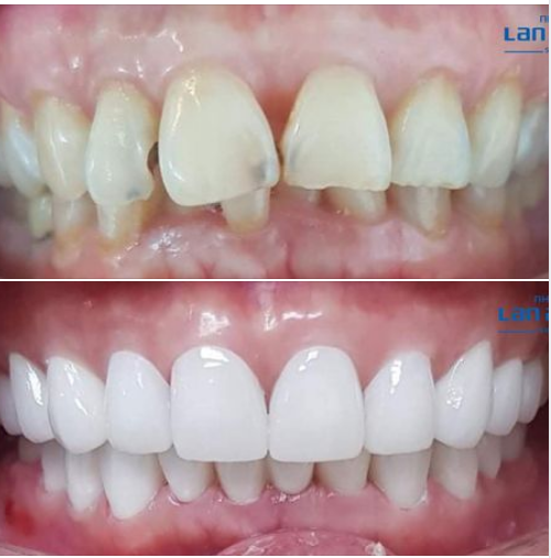 Để đạt được kết quả tốt nhất khi làm răng sứ, nha khoa Lan Anh trang bị labo sản xuất răng sứ ngay tại nha khoa, giúp khách hàng cảm nhận và biết chắc chắn răng sứ của mình được làm với “cái tâm” cao
