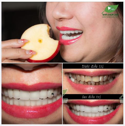 Để răng sứ luôn chắc khỏe, bền đẹp, các bác sĩ bọc răng sứ đưa ra hướng dẫn chế độ chăm sóc răng sau bọc sứ