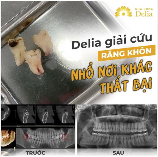 DELIA GIẢI CỨU NHỖ RĂNG KHÔN NƠI KHÁC THẤT BẠI