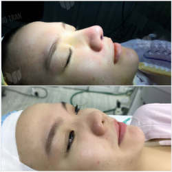 ĐẸP NGAY SAU PHẪU THUẬT LÀ CÓ THẬT