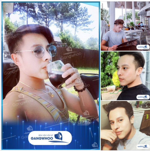 Điều gì đã tạo nên khác biệt dành riêng cho nam giới khi nâng mũi tại TM Gangwhoo