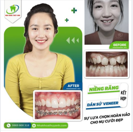 ĐIỀU TRỊ KHỚP CẮN NGƯỢC HIỆU QUẢ VỚI NIỀNG RĂNG